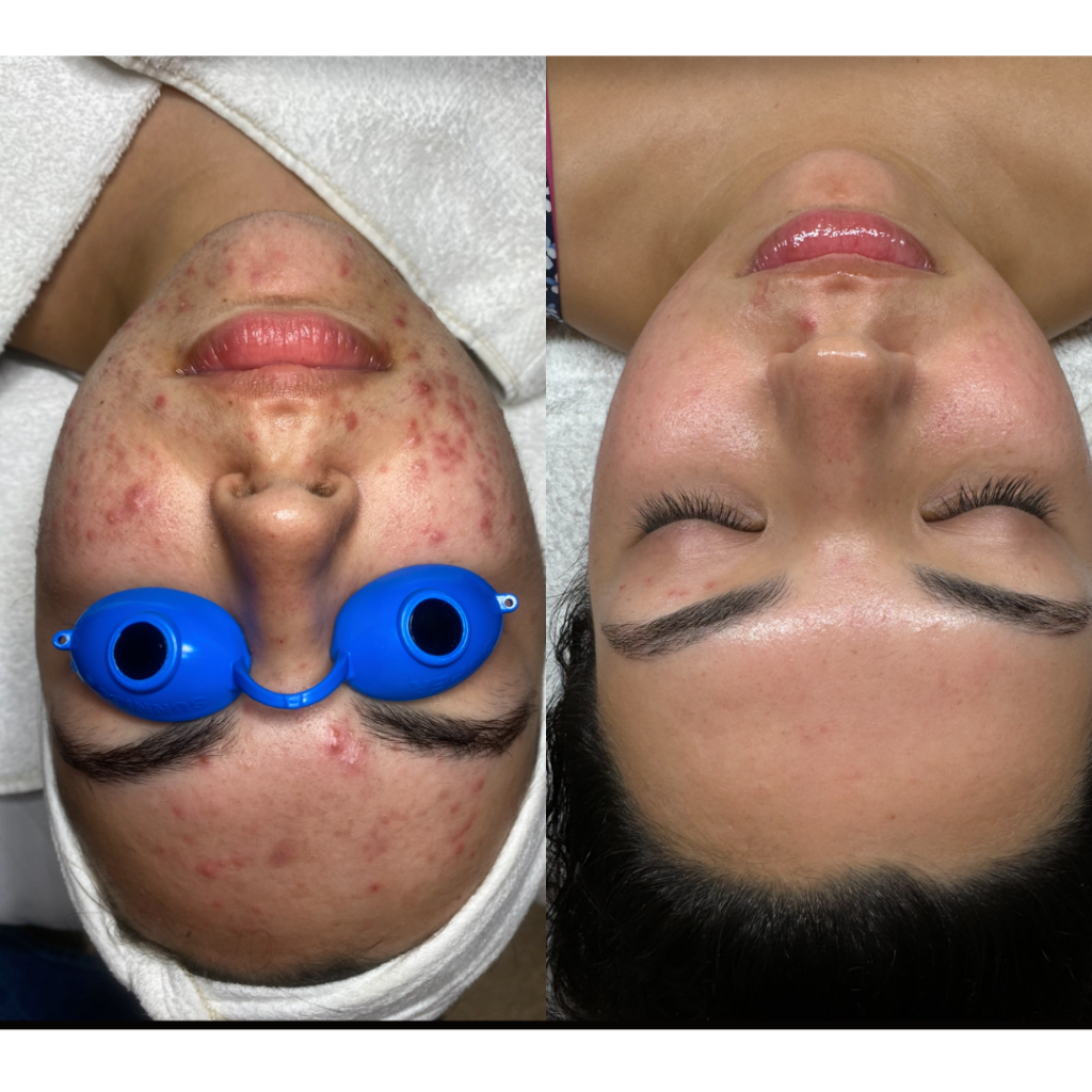 Before & After Facial