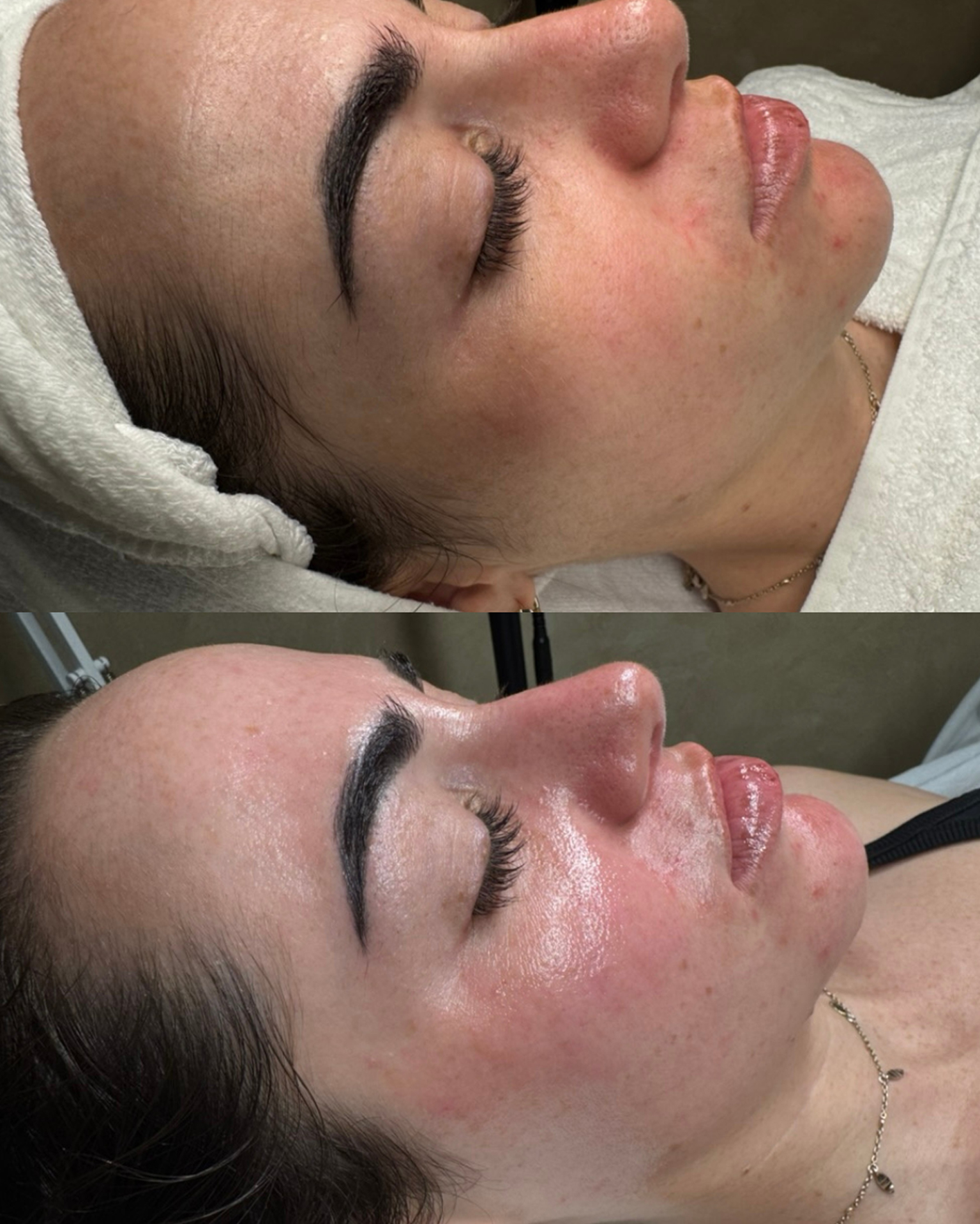 Dermaplaning