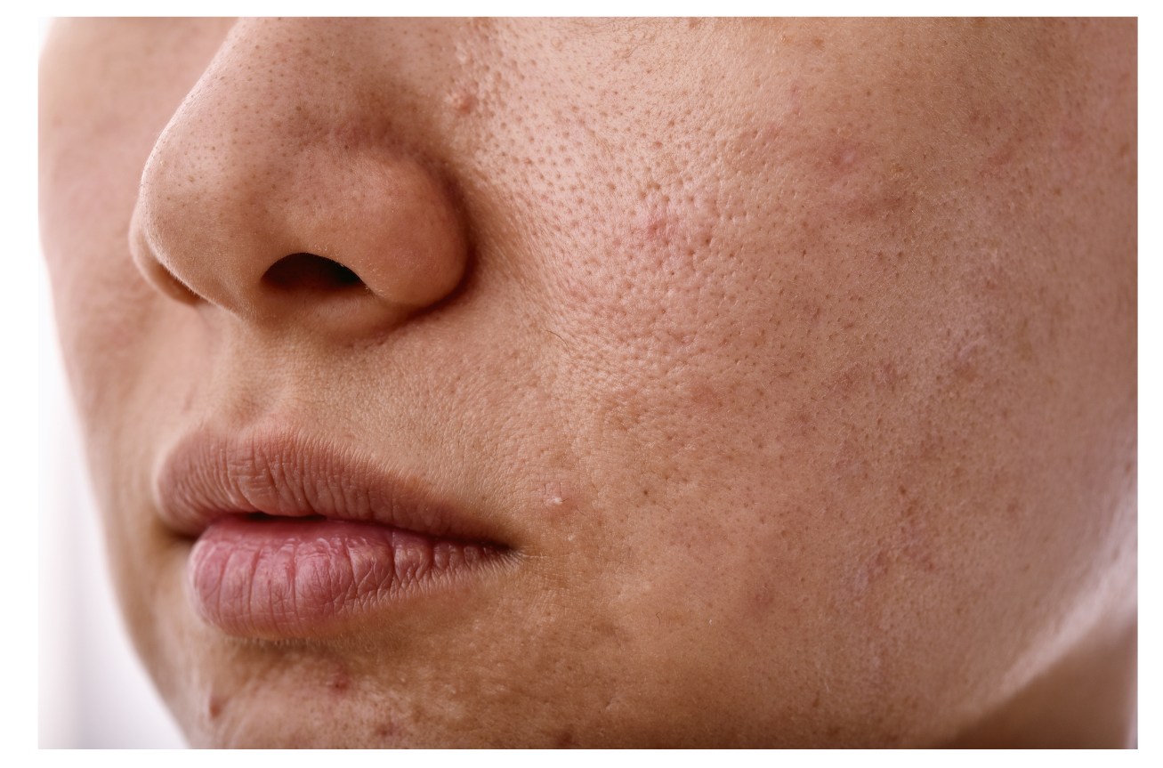 Hyperpigmentation acne